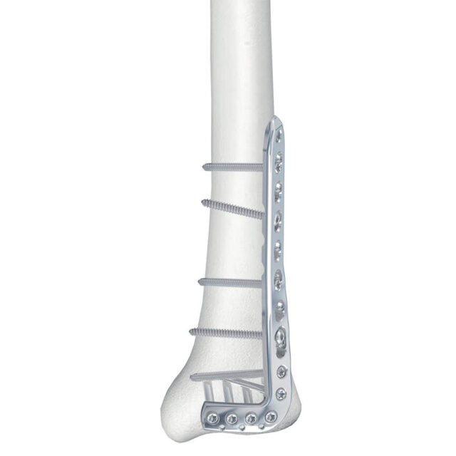 3.5mm LCP® Anterolateral Distal Tibia Plates to SYS Medtech