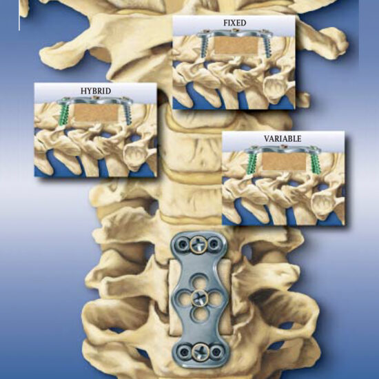 ATLANTISTM Anterior Cervical Plate System to SYS Medtech