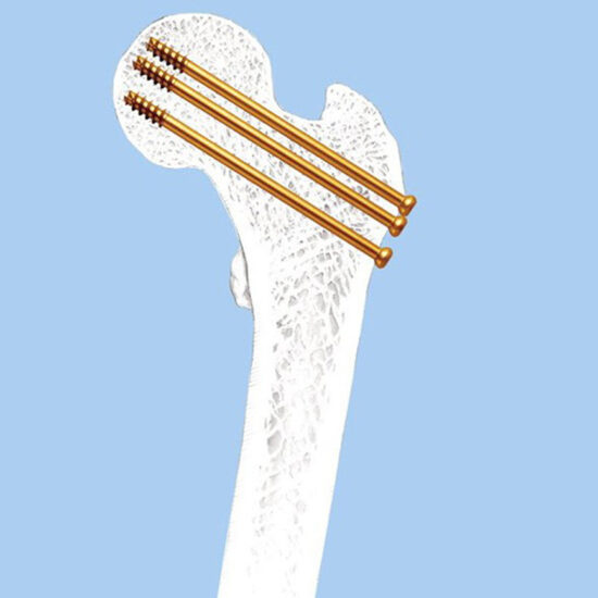 6.5 mm and 7.3 mm Cannulated Screws to SYS Medtech