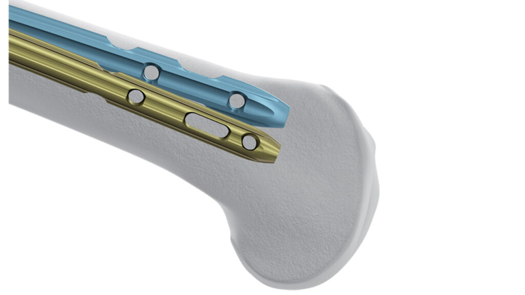 Femoral Recon Nail to SYS MEDTECH INTERNATIONAL PRIVATE LIMITED