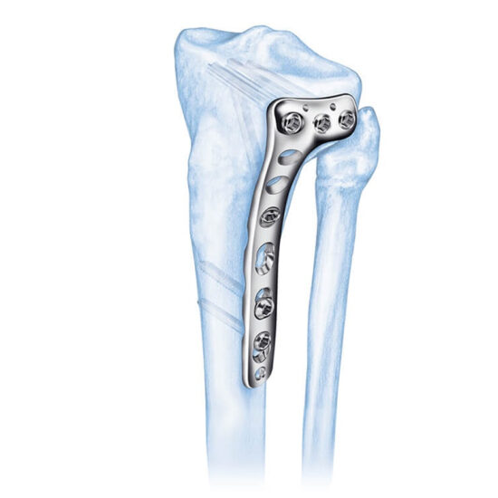 45 Mm Lcp® Proximal Tibia Plate Welcome To Sys Medtech International