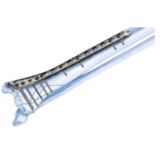 3 5mm LCP Medial Distal Tibia Plate Welcome To SYS Medtech 3 5mm LCP Medial Distal Tibia Plate Welcome To SYS Medtech