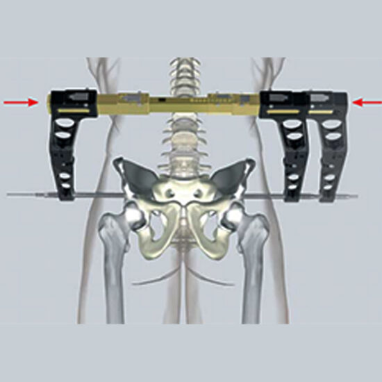 Pelvic CClamp II to SYS Medtech International Pvt. Ltd.