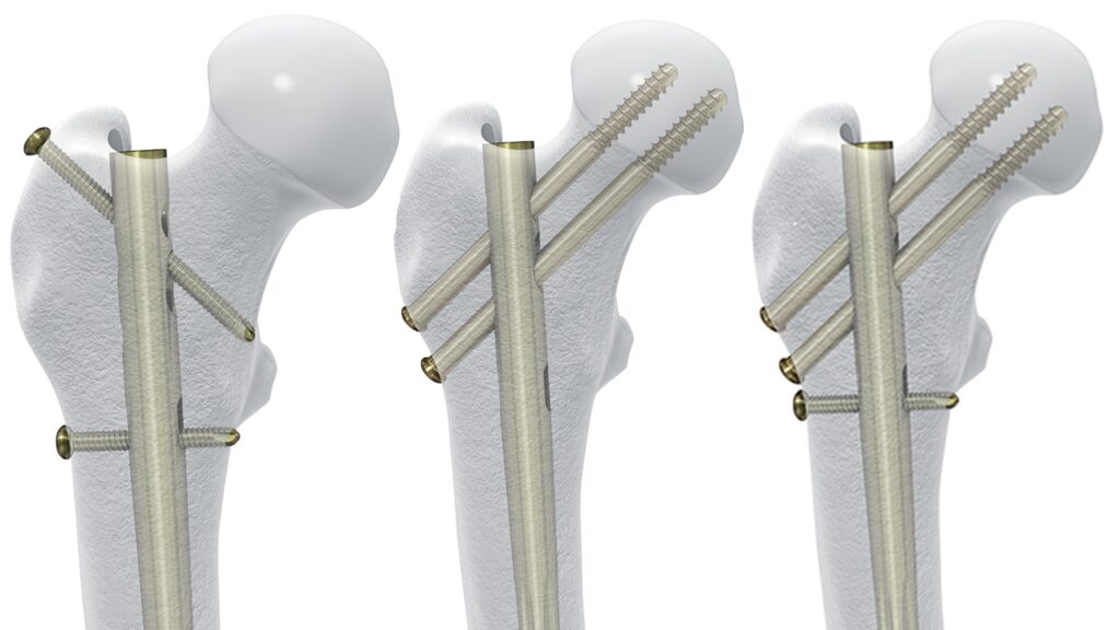 Femoral Recon Nail to SYS MEDTECH INTERNATIONAL PRIVATE LIMITED