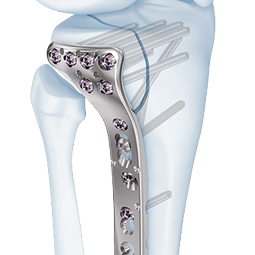 3 5mm VA LCP Proximal Tibia Plate Welcome To SYS Medtech 3 5mm VA LCP Proximal Tibia Plate Welcome To SYS Medtech