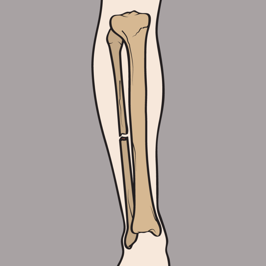 What is Fibula Fractures? to SYS Medtech International Pvt. Ltd.