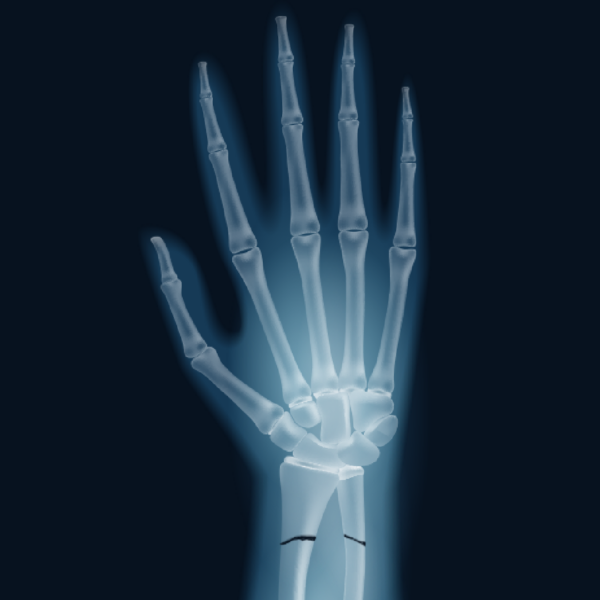 Causes of distal radius fracture to SYS Medtech International