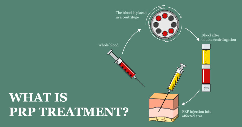 What is PRP Treatment? to SYS MEDTECH INTERNATIONAL PRIVATE