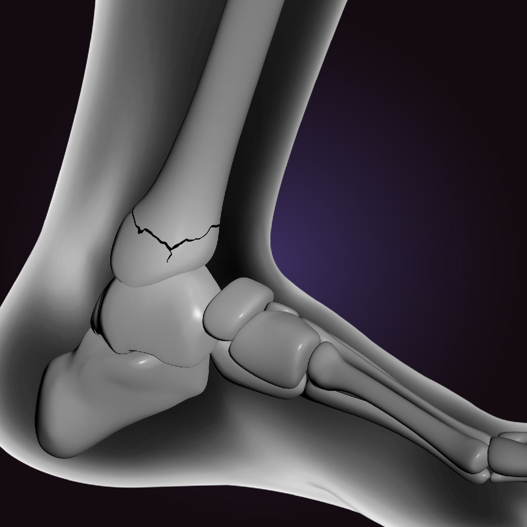 Causes of Ankle Fracture to SYS Medtech International Pvt. Ltd.