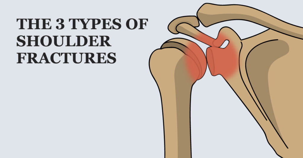 Types of Shoulder Fractures – Welcome to SYS Medtech International Pvt