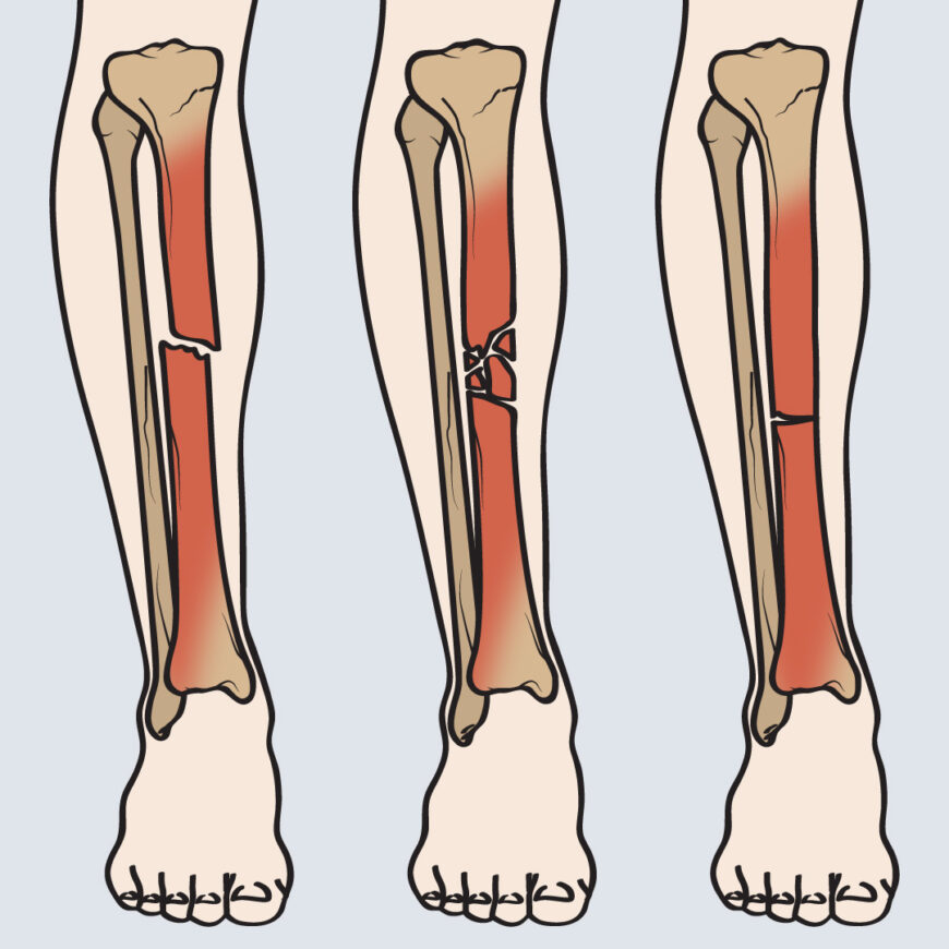 Types of tibia fracture to SYS Medtech International Pvt. Ltd.