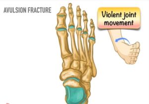 Avulsion fracture
