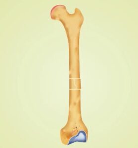 Displaced fracture