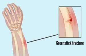Greenstick fracture