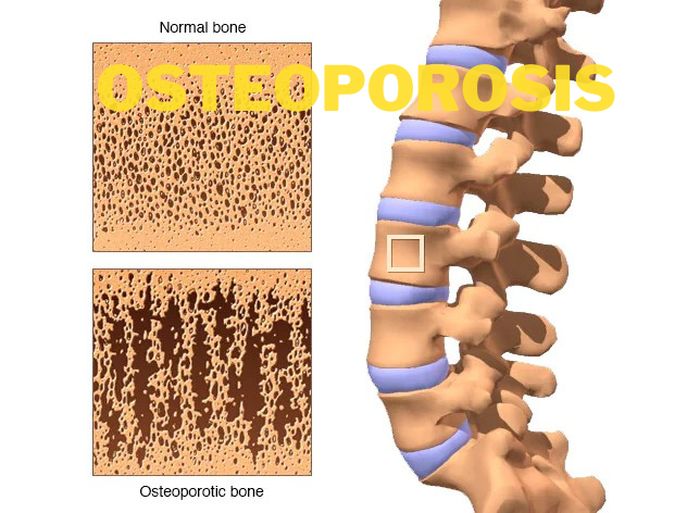 Osteoporosis Featured Image