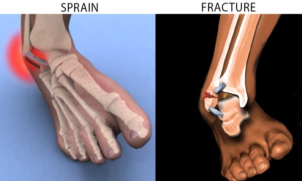 Sprain-VS-Fracture