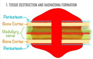 Tissue Destruction and Haematoma formation