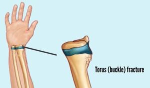 Torus (buckle) fracture
