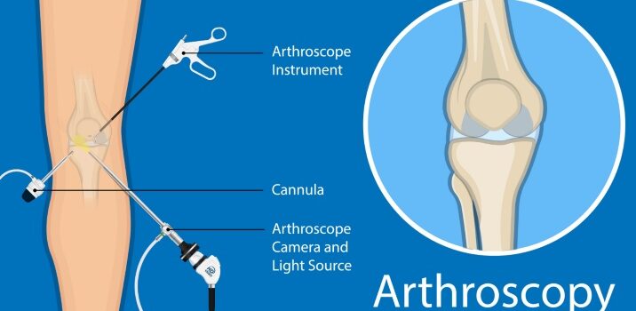 arthroscopy-procedure