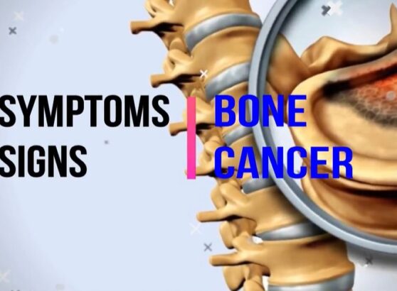 Bone Cancer Signs (Featured Image)