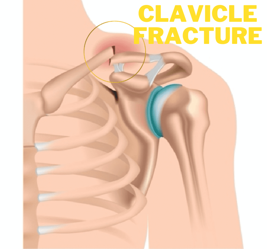 clavicle fracture featured image