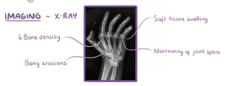 Arthritis X-rays