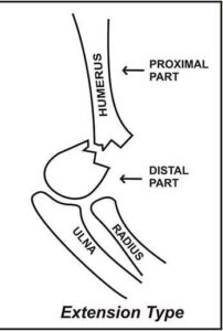 Extension-type-supracondylar-fracture