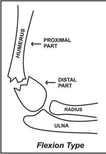Flexion-type-supracondylar-fracture