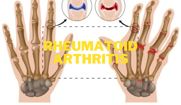Rheumatoid Arthritis featured Image