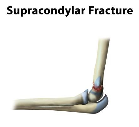 Supracondylar Fracture Featured Image (2)