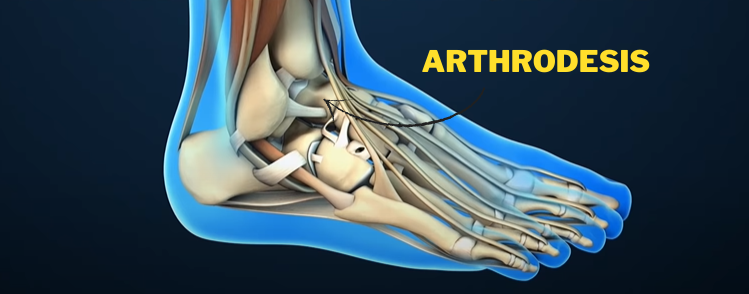 Arthrodesis (Featured Image)