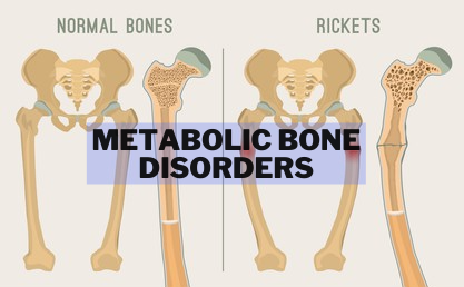 Metabolic Bone Disorders (Featured Image)