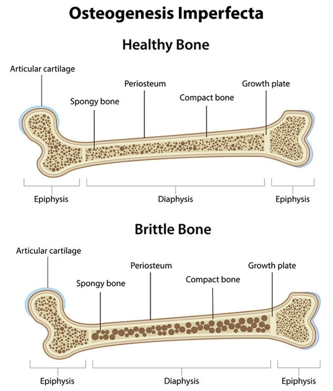 Osteogenesis Imperfecta (Featured Image)