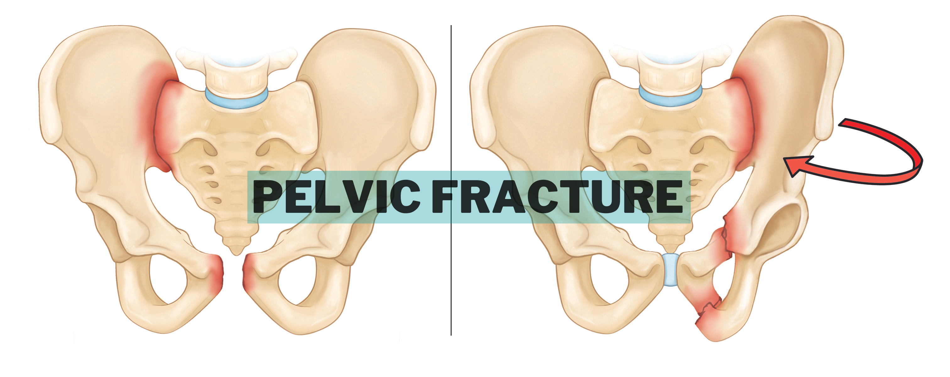Pelvic fracture (featured Image)