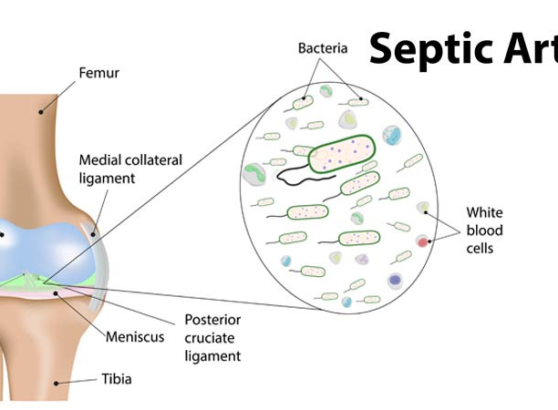 Septic Arthritis (Featured Image)