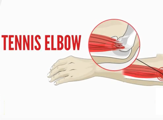 Tennis Elbow (Featured Image)