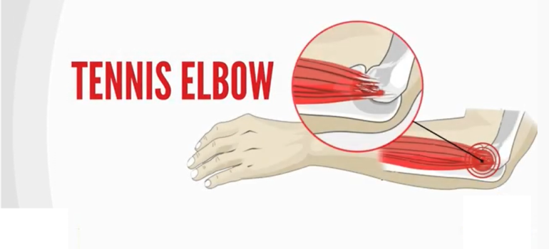 Tennis Elbow (Featured Image)