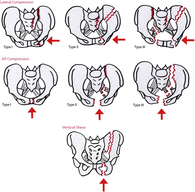 Three types of pelvic fracture