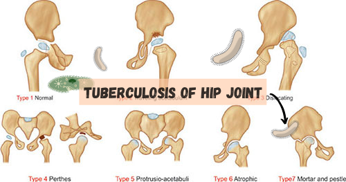 Tuberculosis of hip (Featured Image)