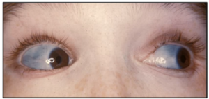 sclera eyes